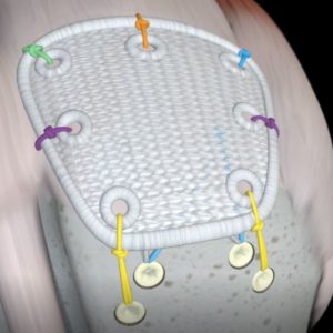 Pitch-Patch Soft Tissue Reinforcement Device