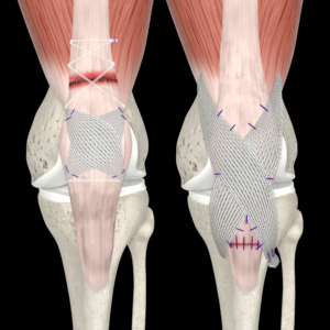 Extensor Mechanism Reinforcement with 30 mm Poly-Tape